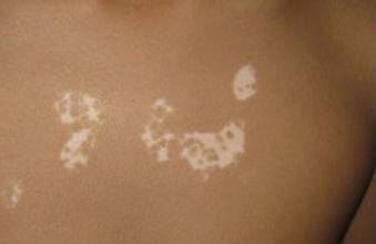 如何减少治疗白癜风费用 如何减少治疗白癜风费用