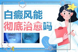 白点癫风外用什么药治快-怎样才能治好[解决方案]