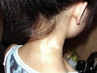 女性白癜风要注意哪些穿衣方面的事项 女性白癜风要注意哪些穿衣方面的事项