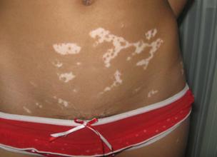 儿童为什么会白癜风