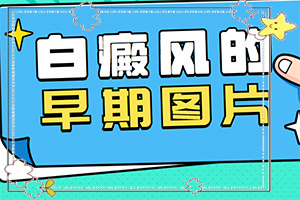 卤米松三氯生乳膏和他克莫司软膏联用治疗白斑(要点有哪些)-儿童早期白癫疯症状及预防和治疗