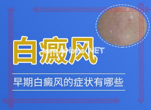 怎样才能治好白斑-科学治疗很关键[关注]