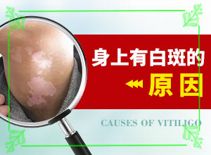 轻度白癞风可以自己好吗-白毛病简单治疗-如何治疗白癜风