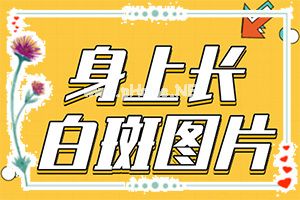 白点癫风应该多吃什么-怎样才能治好[真实案例]