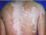 白癜风治疗期间怎么护理