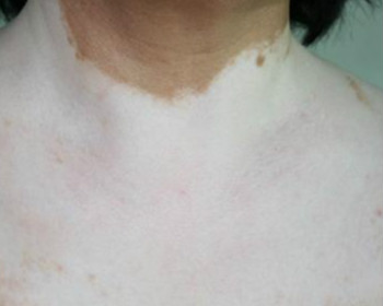 怎么做才能防止手部白癜风的扩散 怎么做才能防止手部白癜风的扩散